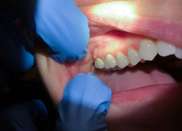 Best Dental Abscess Treatment in Cattaraugus, NY